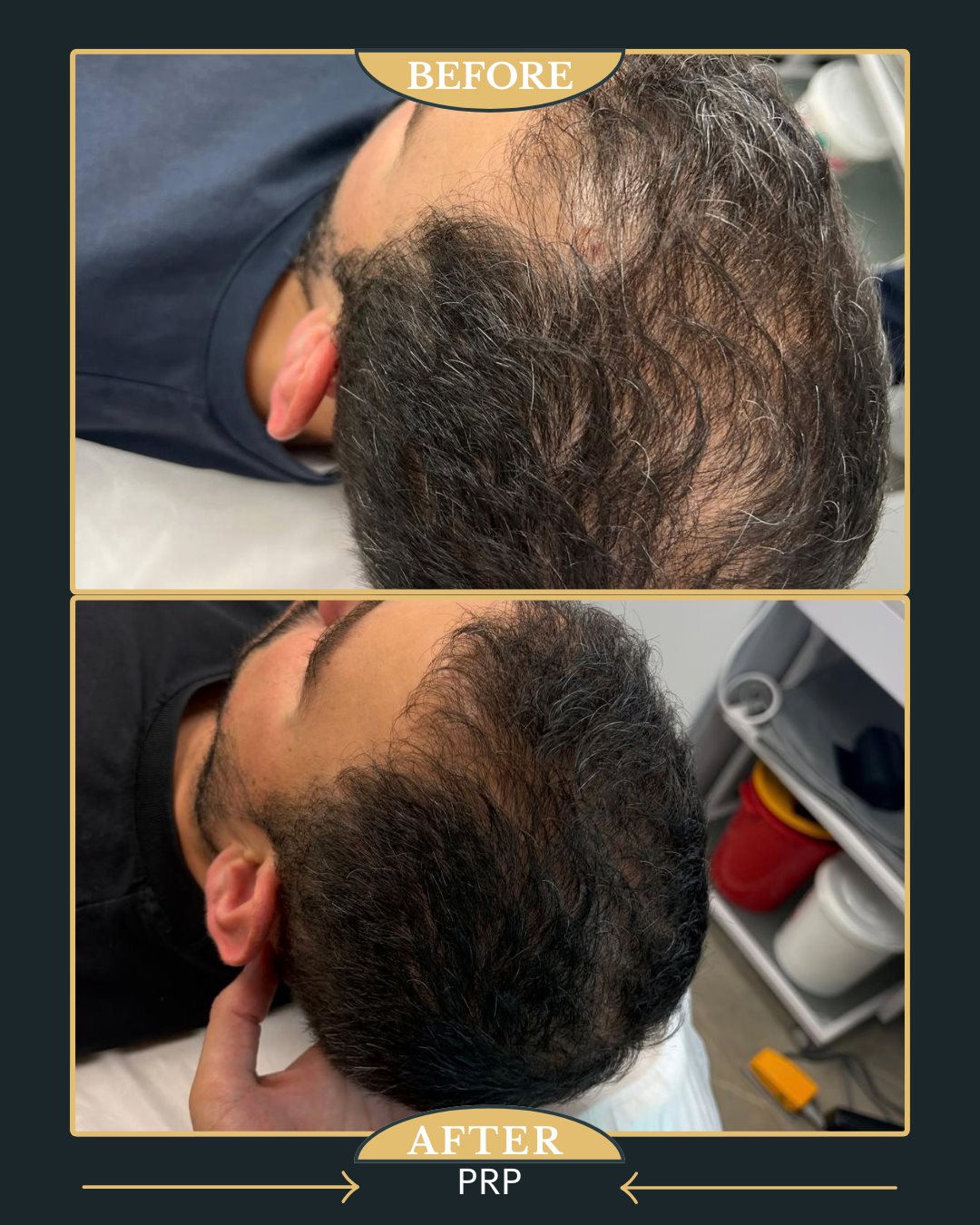 PRP לשיער לפני ואחרי - מרום מדיקל קליניק בני ברק (5)